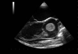 HCM - Formazione di un trombo a livello dell'atrio sinistro