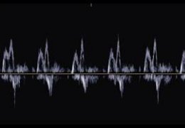 Cardiomiopatia Ipertrofica Gatto - Profilo diastolico da alterato rilasciamento E/A <1
