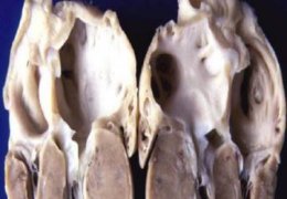 HCM Felina - Reperto anatomopatologico