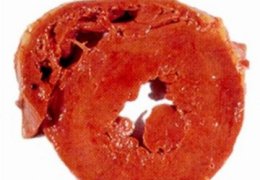 HCM Felina - Reperto anatomopatologico